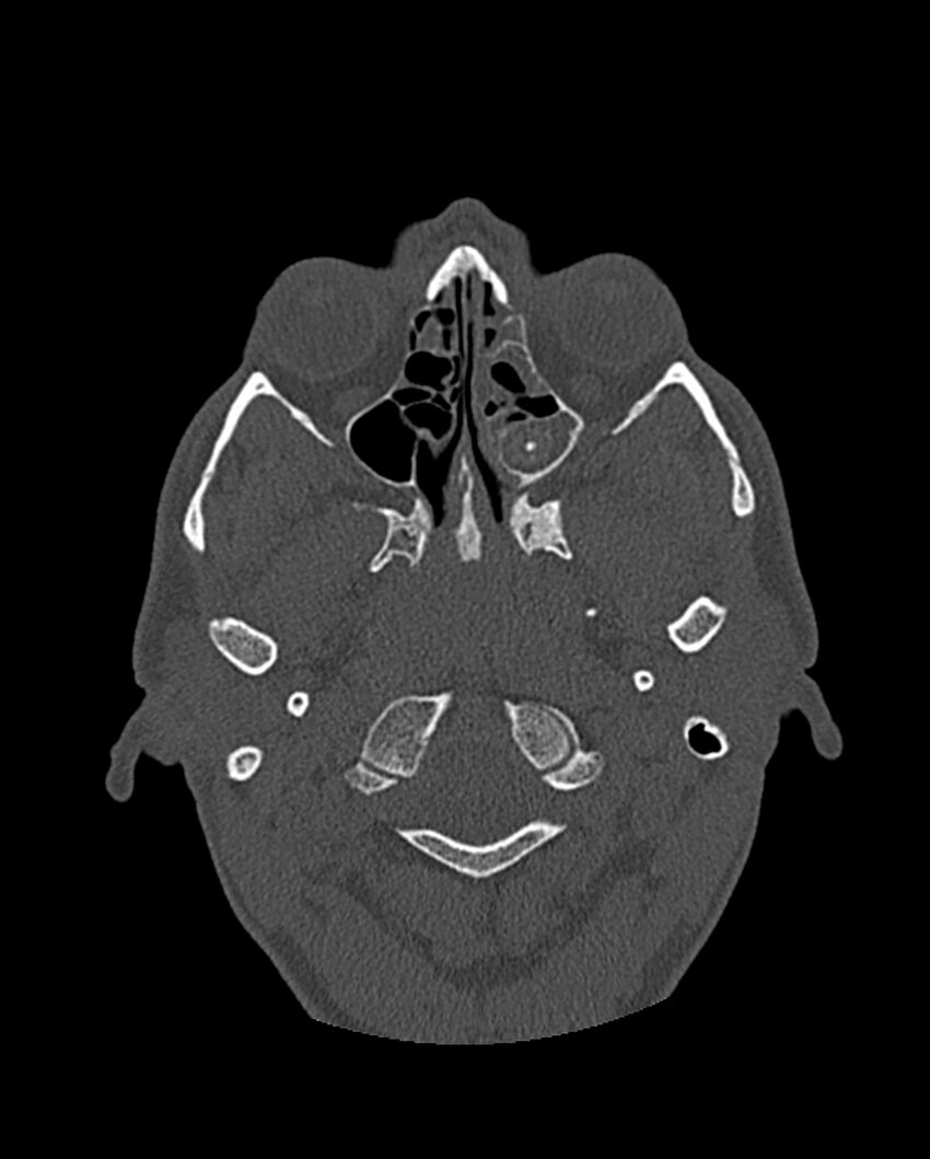 Chronic maxillary sinusitis caused by a foreign body (Radiopaedia 58521-65676 Axial bone window 174).jpg