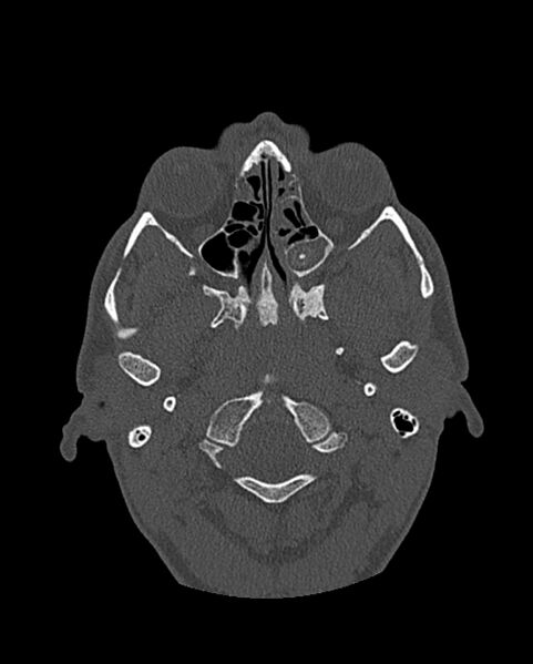 File:Chronic maxillary sinusitis caused by a foreign body (Radiopaedia 58521-65676 Axial bone window 178).jpg