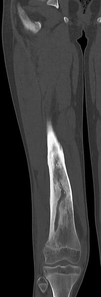 File:Chronic ostemyelitis of the femur with long sinus tract (Radiopaedia 74947-85982 Coronal bone window 45).jpg
