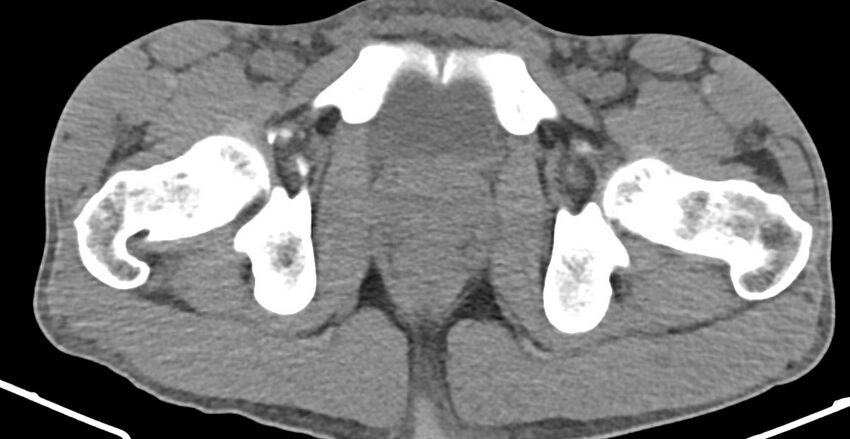Chronic osteomyelitis (with sequestrum) (Radiopaedia 74813-85822 D 43).jpg