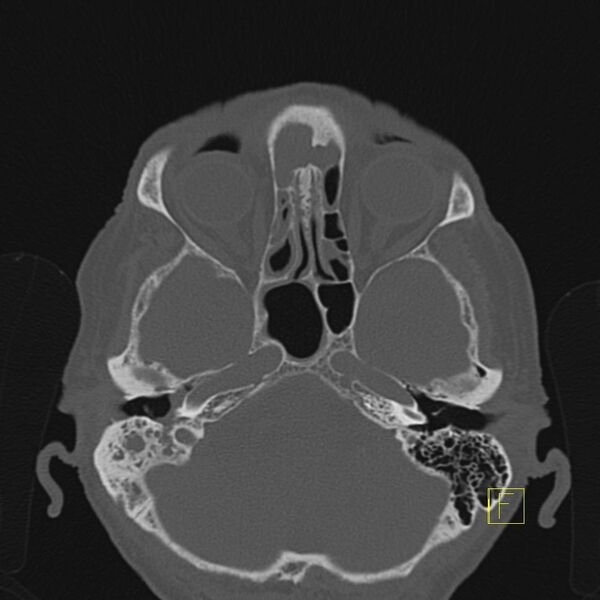 File:Chronic otitis media (Radiopaedia 14994-14912 Axial bone window 15).JPEG