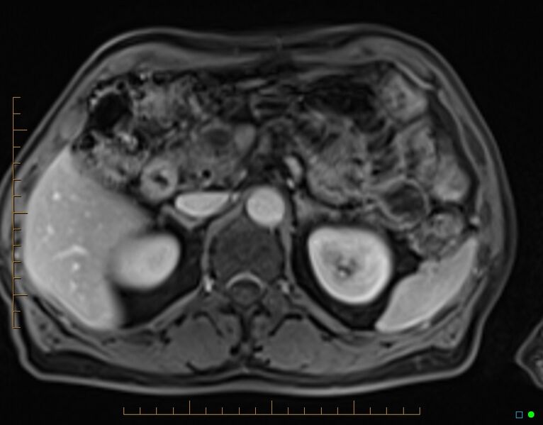 File:Chronic pancreatitis (Radiopaedia 17014-16716 Axial T1 C+ fat sat 29).jpg