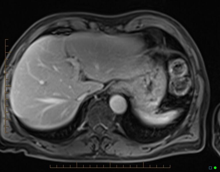 File:Chronic pancreatitis (Radiopaedia 17014-16716 Axial T1 C+ fat sat 7).jpg