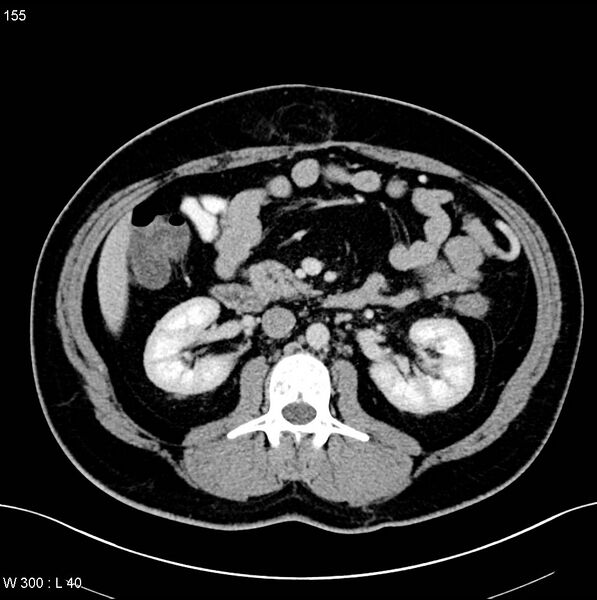 File:Chronic pancreatitis and pseudocysts (Radiopaedia 6724-7935 D 13).jpg