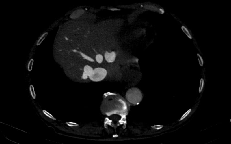 File:Chronic pulmonary embolism (Radiopaedia 91241-108843 B 161).jpg