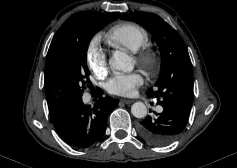 File:Chronic pulmonary embolism with bubbly consolidation (Radiopaedia 91248-108850 C+ arterial phase 86).jpg