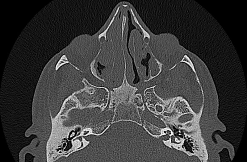 File:Chronic rhinosinusitis (Radiopaedia 65079-74075 Axial bone window 40).jpg