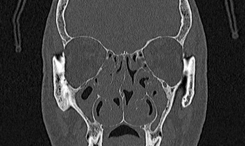 File:Chronic rhinosinusitis (Radiopaedia 65079-74075 Coronal bone window 37).jpg
