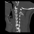 Clay-shoveler fracture (Radiopaedia 22568-22590 Sagittal bone window 14).jpg
