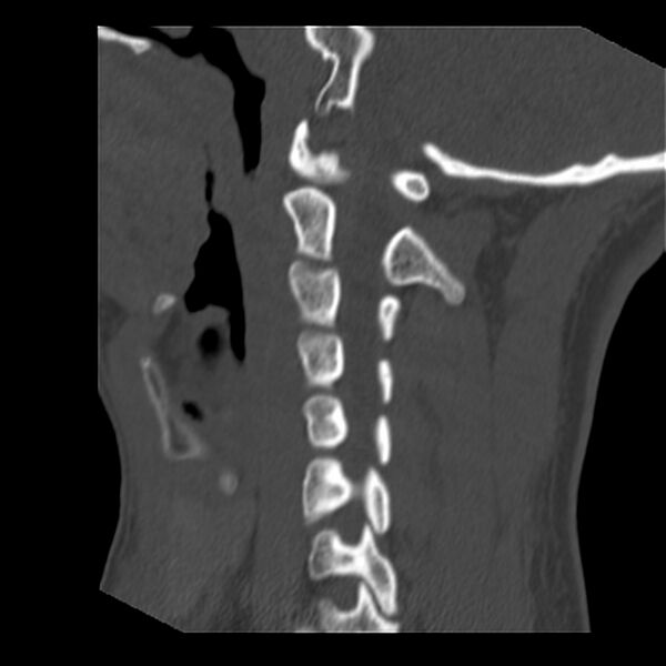 File:Clay-shoveler fracture (Radiopaedia 22568-22590 Sagittal bone window 14).jpg