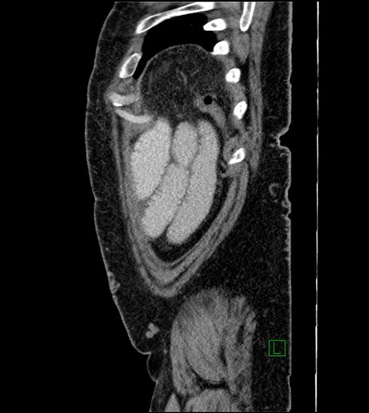 File:Closed-loop small bowel obstruction-internal hernia (Radiopaedia 78439-91096 C 24).jpg