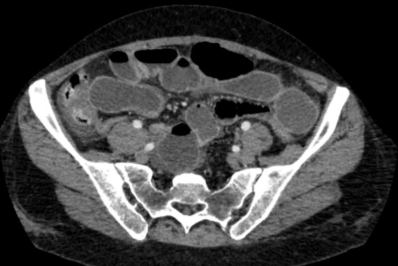 File:Closed loop small bowel obstruction (Radiopaedia 71211-81508 A 111).jpg