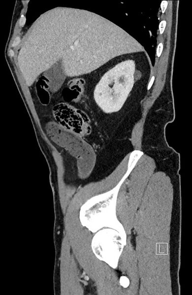 File:Closed loop small bowel obstruction - internal hernia (Radiopaedia 57806-64778 C 86).jpg