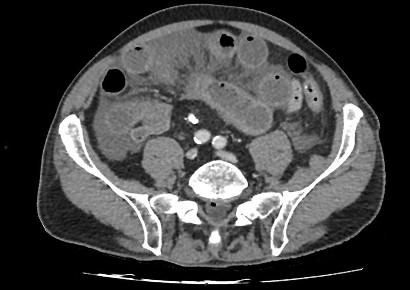 File:Closed loop small bowel obstruction with ischemia (Radiopaedia 84180-99456 A 82).jpg