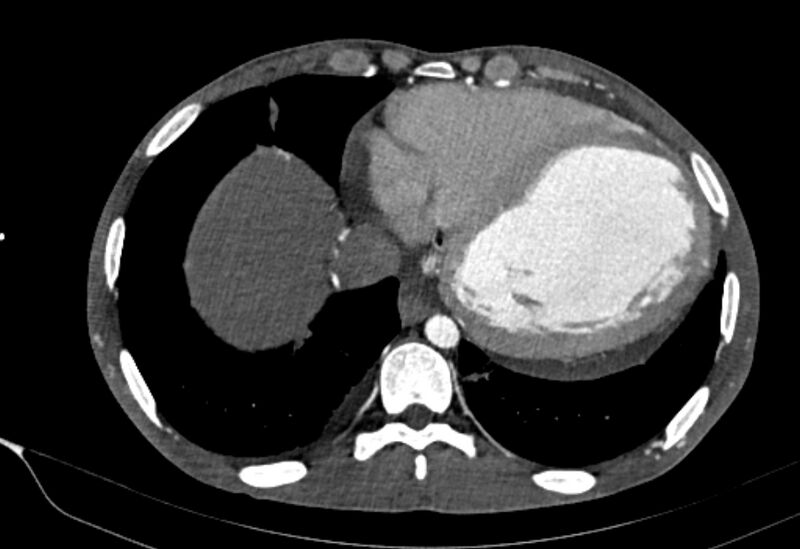 File:Coarctation of aorta with aortic valve stenosis (Radiopaedia 70463-80574 A 177).jpg