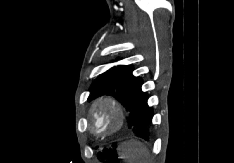 File:Coarctation of aorta with aortic valve stenosis (Radiopaedia 70463-80574 B 225).jpg