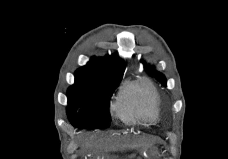 File:Coarctation of aorta with aortic valve stenosis (Radiopaedia 70463-80574 C 8).jpg