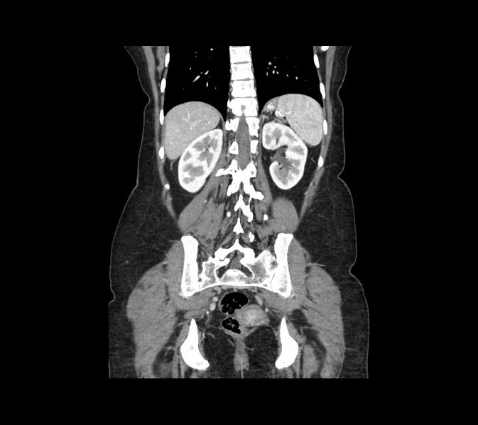File:Cocoon abdomen with possible tubo-ovarian abscess (Radiopaedia 46235-50636 B 40).jpg