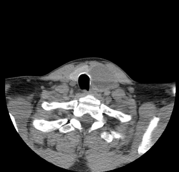 File:Colloid cyst of thyroid (Radiopaedia 22897-22923 Axial non-contrast 44).jpg