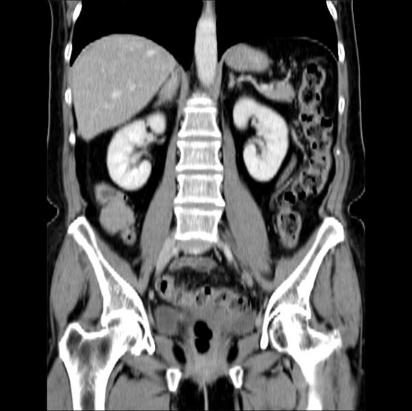 File:Colon carcinoma with hepatic metastases (Radiopaedia 29477-29961 B 26).jpg