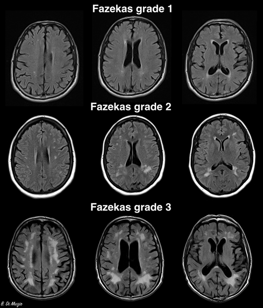 File:Fazekas scale for white matter lesions (Radiopaedia 36927).png