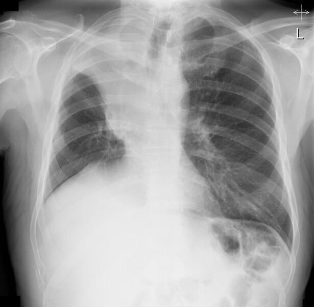 File:Golden S sign with rib and clavicle metastases (Radiopaedia 74250).jpg