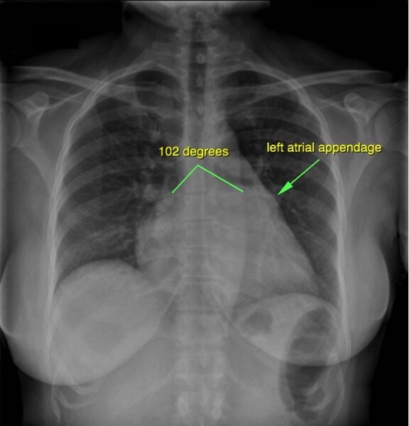 File:Left atrial enlargement due to mitral stenosis (Radiopaedia 40829).jpg