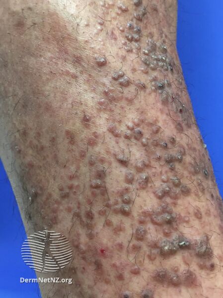 File:Lichen amyloidosis (DermNet NZ lichen-amyloidosis-03).jpg