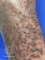 Lichen amyloidosis (DermNet NZ lichen-amyloidosis-03).jpg