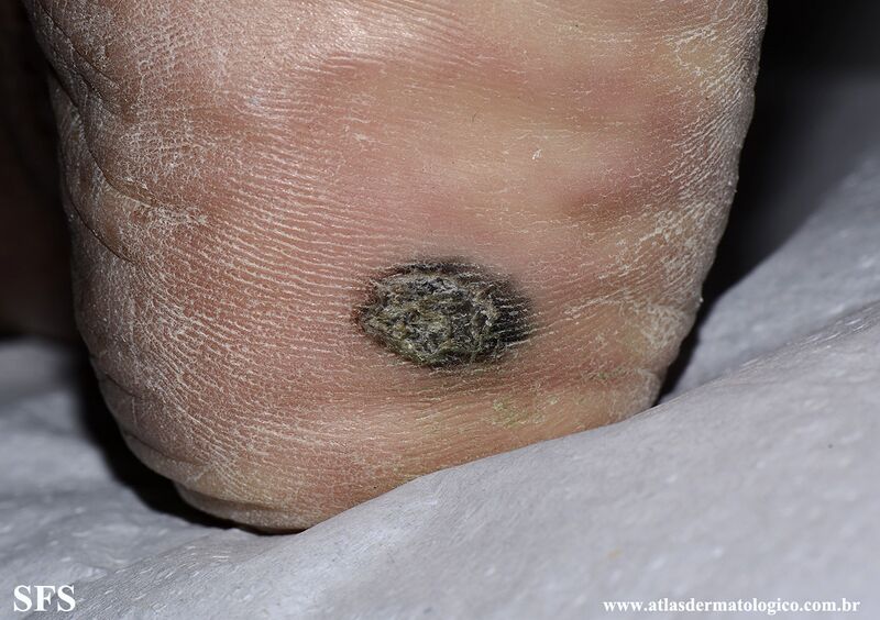 File:Melanoma (Dermatology Atlas 114).jpg
