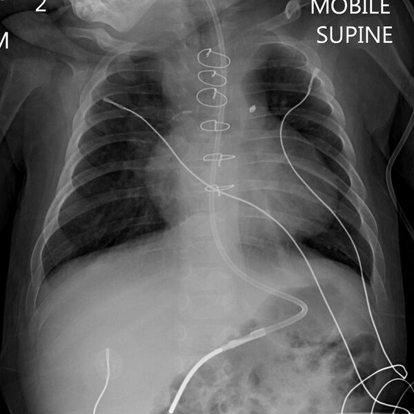 File:Nasogastric tube in right lower lobe bronchus (Radiopaedia 24275-24547 Frontal 1).jpg