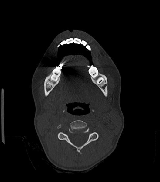 File:Nasoorbitoethmoid fracture (Radiopaedia 90044-107205 Axial bone window 34).jpg