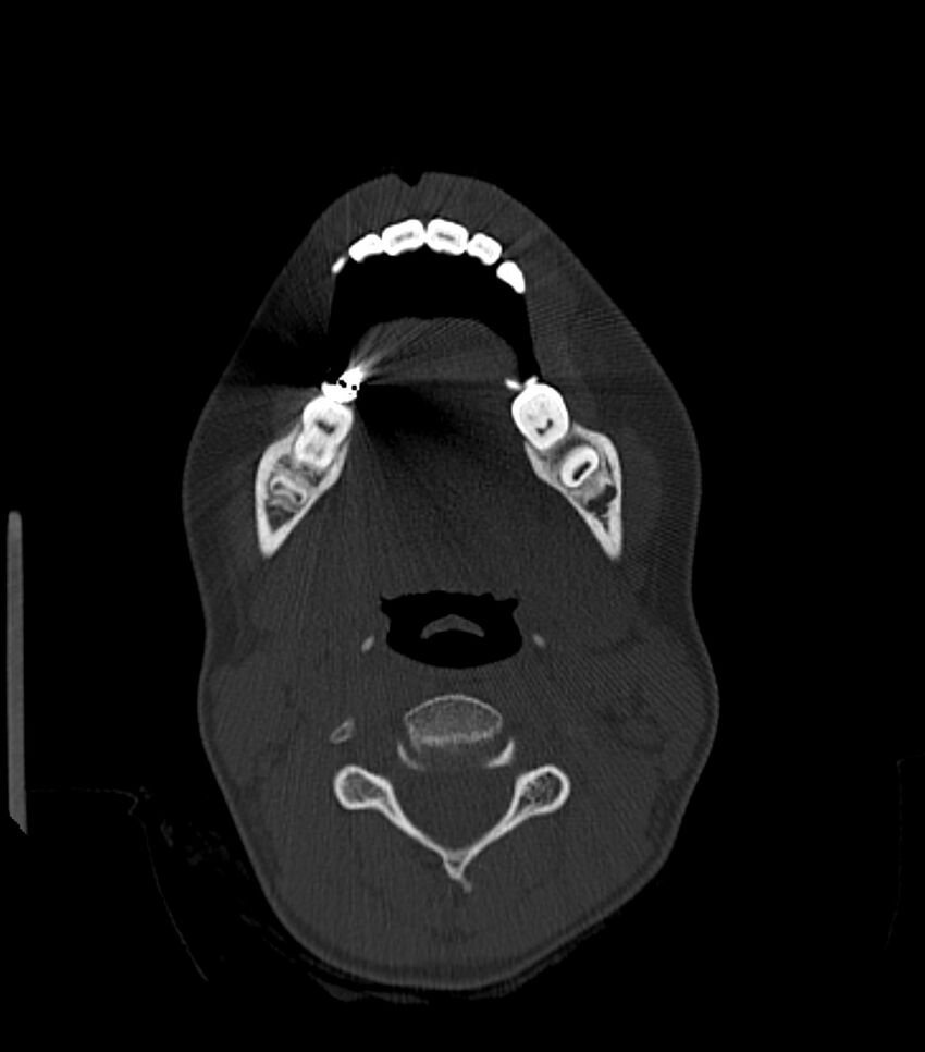 Nasoorbitoethmoid fracture (Radiopaedia 90044-107205 Axial bone window 34).jpg