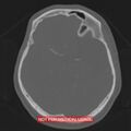 Nasopharyngeal carcinoma recurrence - skull base destruction (Radiopaedia 29107-29490 Axial bone window 61).jpg