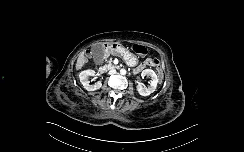 Neo-terminal ileal stricture (Crohn disease) (Radiopaedia 33790-34948 A 177).jpg
