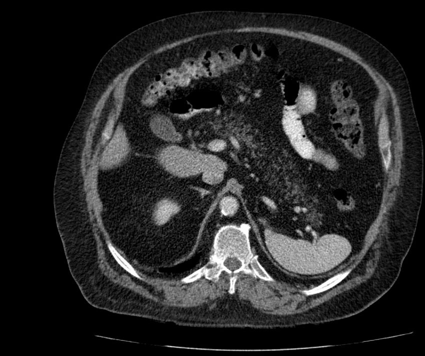 Nephroptosis with inguinal hernia containing perirenal fat (Radiopaedia 56632-63391 C 103).jpg