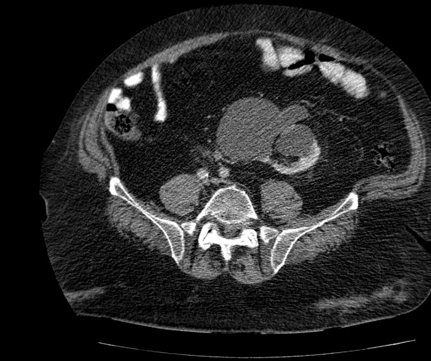 Nephroptosis with inguinal hernia containing perirenal fat (Radiopaedia 56632-63391 C 237).jpg