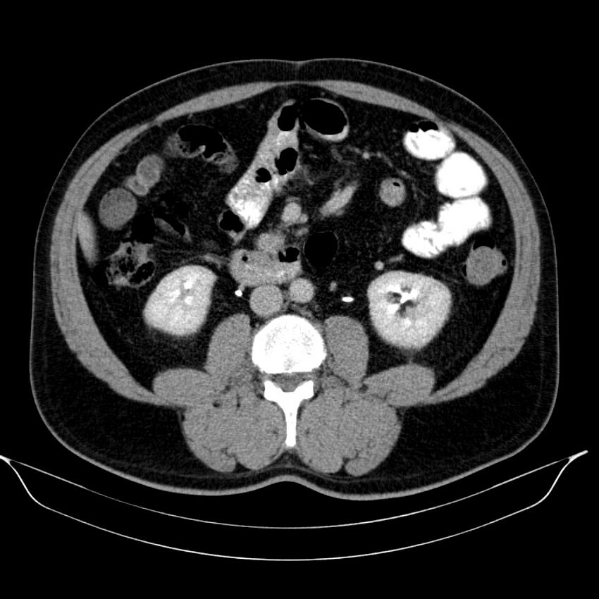 Neuroendocrine tumor of head of pancreas (Radiopaedia 57538-64502 D 44).jpg
