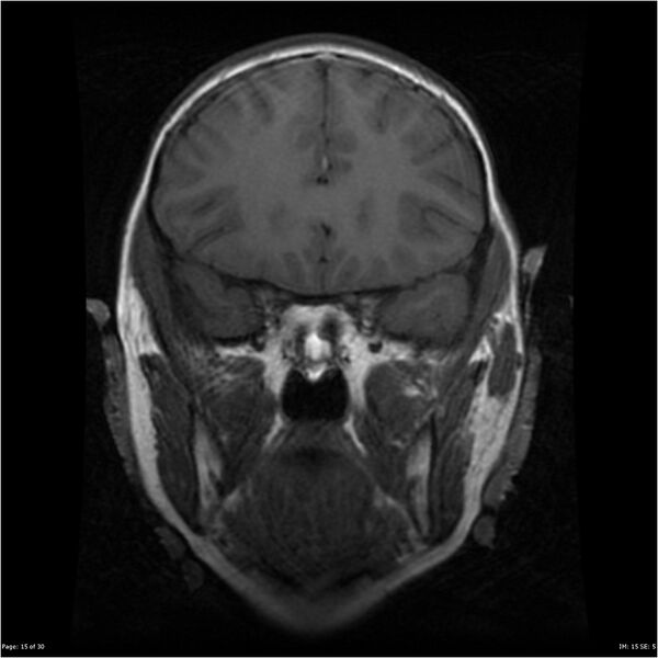 File:Neurofibromatosis type 1 (Radiopaedia 22541-22564 Coronal T1 24).jpg