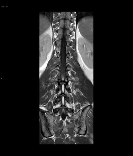 File:Neurofibromatosis type 1 (Radiopaedia 36933-38560 E 15).jpg