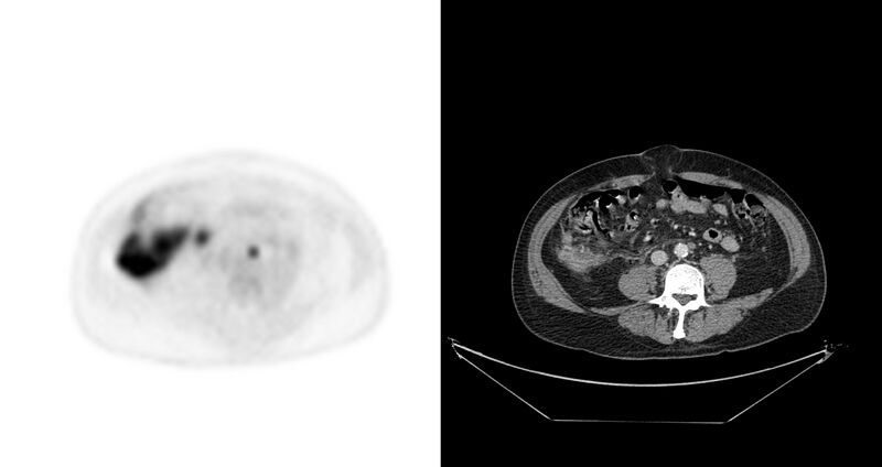 File:Non-Hodgkin lymphoma involving seminal vesicles with development of interstitial pneumonitis during Rituximab therapy (Radiopaedia 32703-33675 axial PET CT 22).jpg