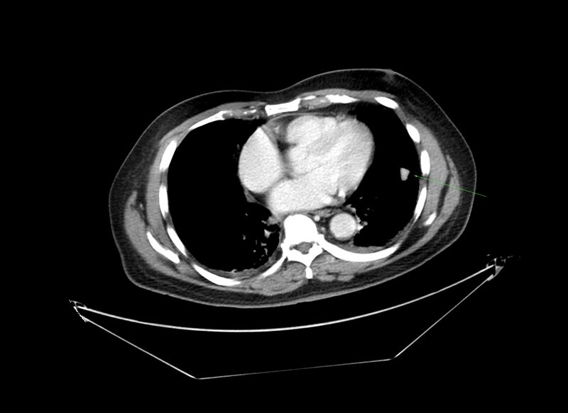 File:Non-Hodgkin lymphoma involving seminal vesicles with development of interstitial pneumonitis during Rituximab therapy (Radiopaedia 32703-33677 Annotated CT 3).jpg