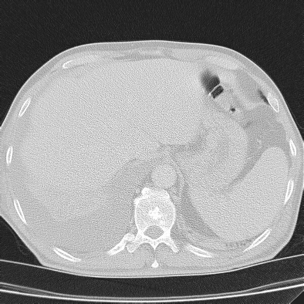 File:Non small-cell lung cancer (Radiopaedia 24467-24769 lung window 48).jpg