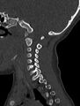 Normal CT cervical spine - pediatric (Radiopaedia 52549-58462 Sagittal bone window 147).jpg