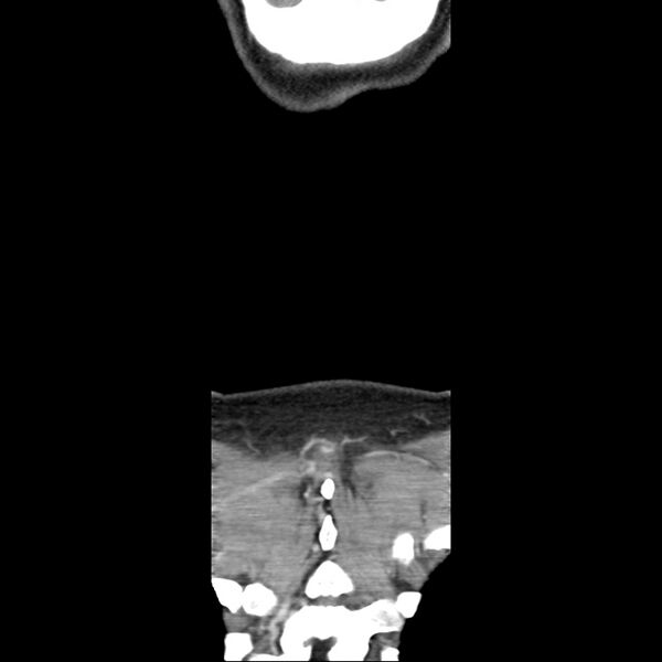 File:Normal CT of the neck (Radiopaedia 14575-14500 Coronal C+ 54).jpg