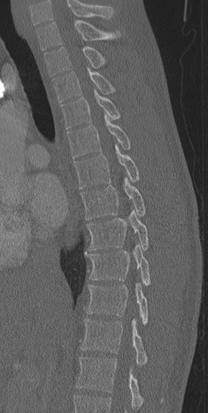File:Normal CT thoracic spine (Radiopaedia 40181-42688 Sagittal bone window 38).png