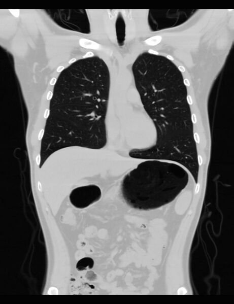 File:Normal CT virtual gastroscopy (Radiopaedia 29960-30501 F 11).jpg