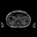 Normal MRI abdomen in pregnancy (Radiopaedia 88001-104541 Axial Gradient Echo 22).jpg