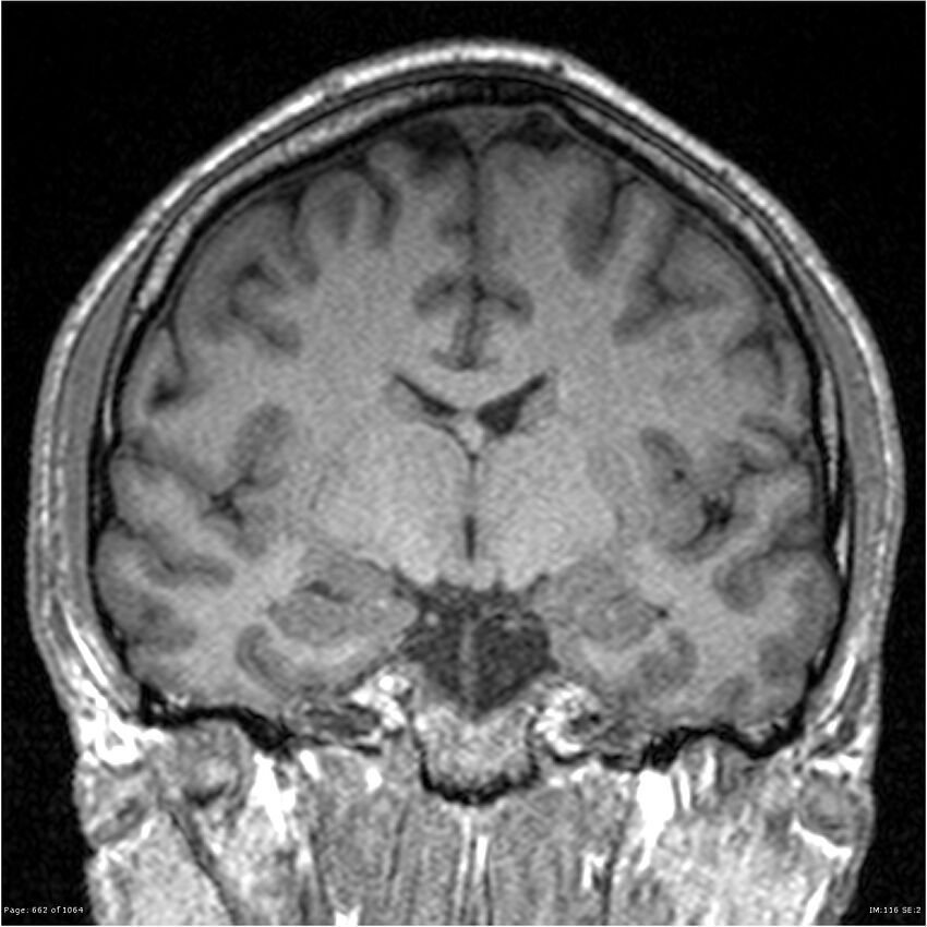 Normal brain MRI (non-focal epilepsy protocol) (Radiopaedia 38571-40700 Coronal T1 57).jpg