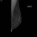Normal breast mammography (tomosynthesis) and ultrasound (Radiopaedia 65325-74355 D 1).jpeg